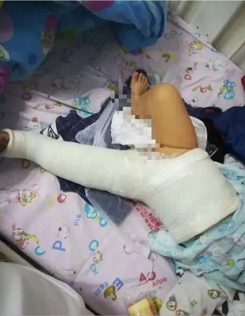 新澳门彩出码走势和被狗主人殴打致骨折与狗被打骨折了怎么办